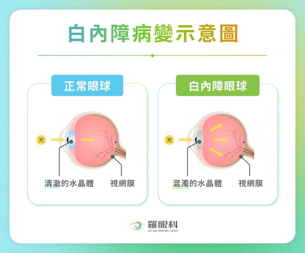 白內障病變示意圖